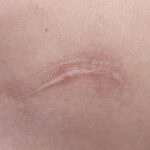 Keloid litteken
